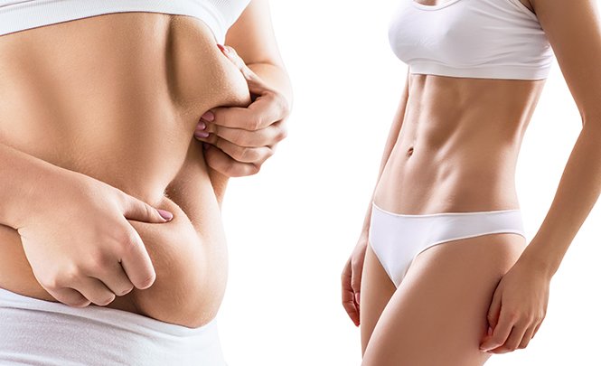 abdominoplastie Tunisie