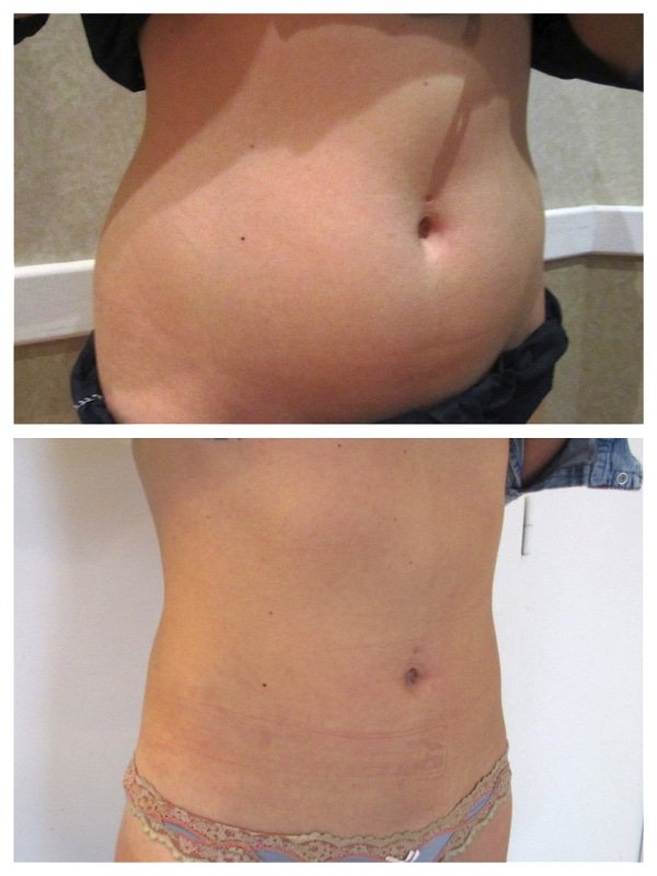 abdominoplastie relooking Tunisie