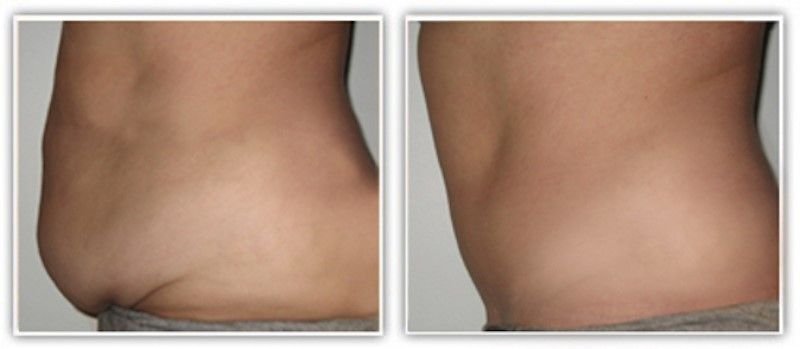 abdominoplastie Tunisie avant et après