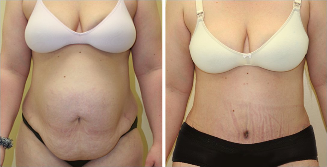 relooking abdominal Tunisie avant et après